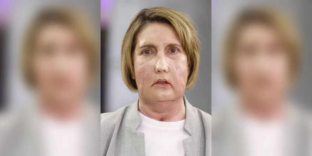 Στην Ισπανία η πρώτη μεταμόσχευση προσώπου από δότρια που υποβλήθηκε σε υποβοηθούμενη ευθανασία