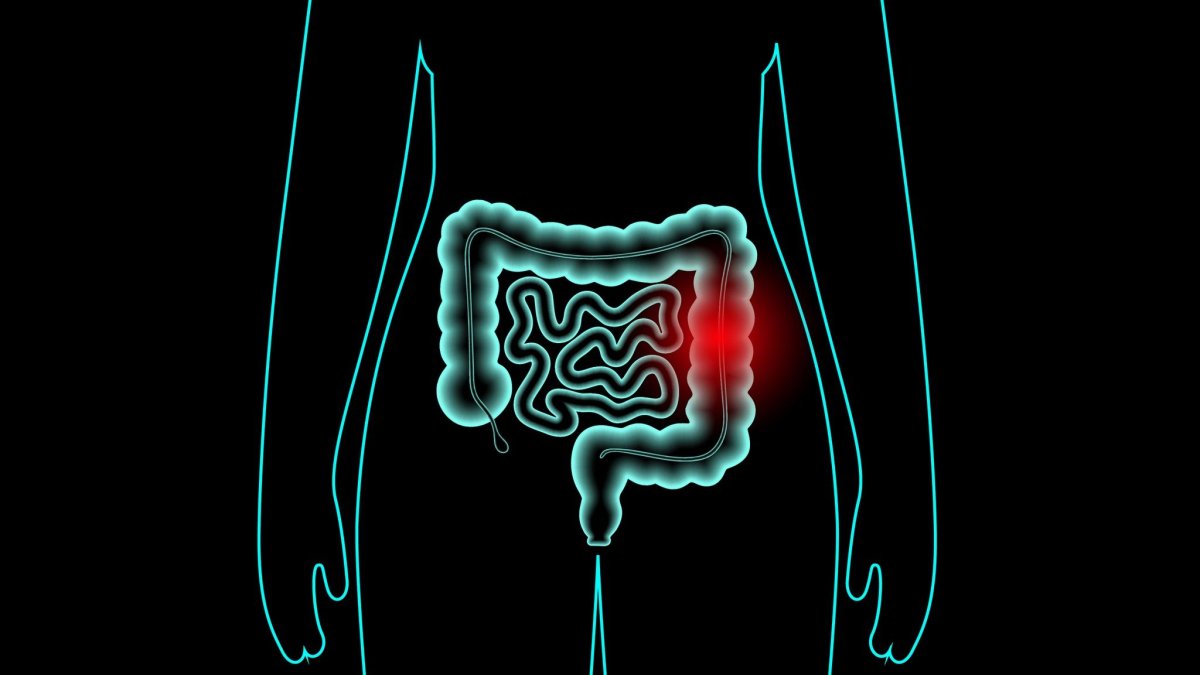 Οι τροφές που μειώνουν τον κίνδυνο καρκίνου του παχέος εντέρου – Ποιες να αποφεύγετε
