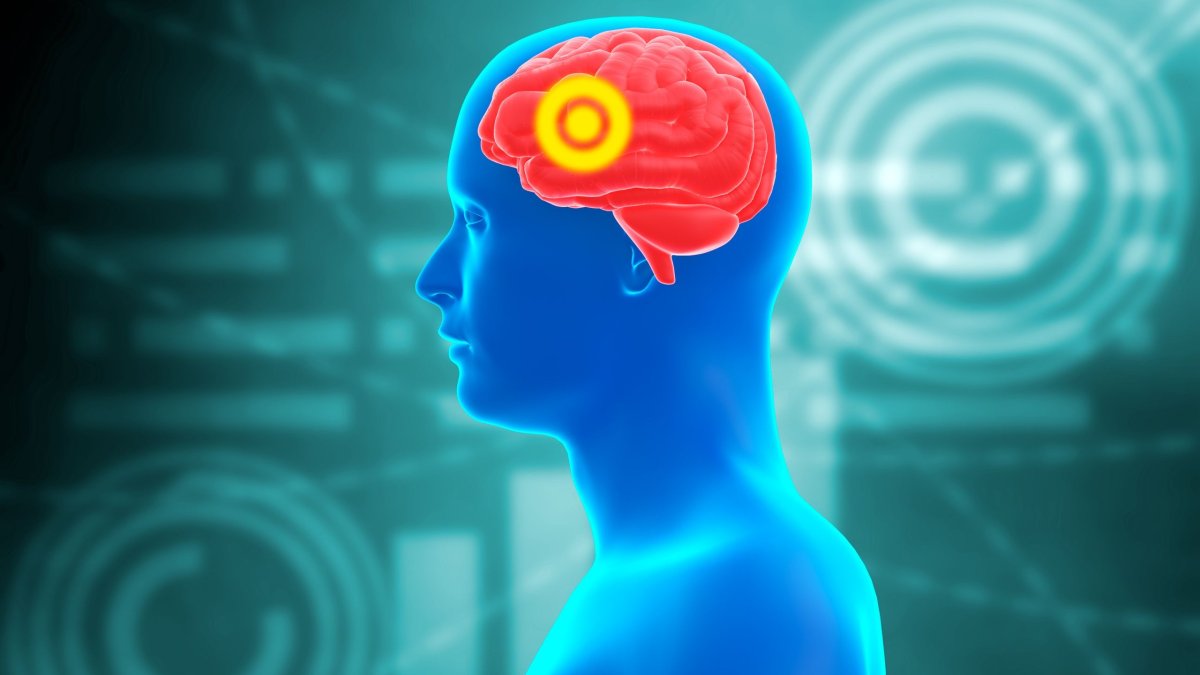 Τι είναι το εγκεφαλικό ανεύρυσμα με το οποίο διαγνώστηκε ο Γ.Μυλωνάκης; – Τα συμπτώματα