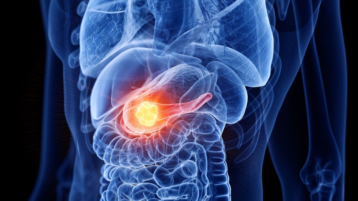 Ελπιδοφόρα νέα μελέτη για τον καρκίνο στο πάγκρεας: Nέο φάρμακο διπλασιάζει το ποσοστό επιβίωσης!