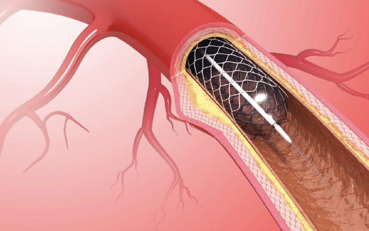 Επιστήμονες ανέπτυξαν stent που κρατά ανοιχτές τις αρτηρίες και στη συνέχεια απορροφάται από τον οργανισμό